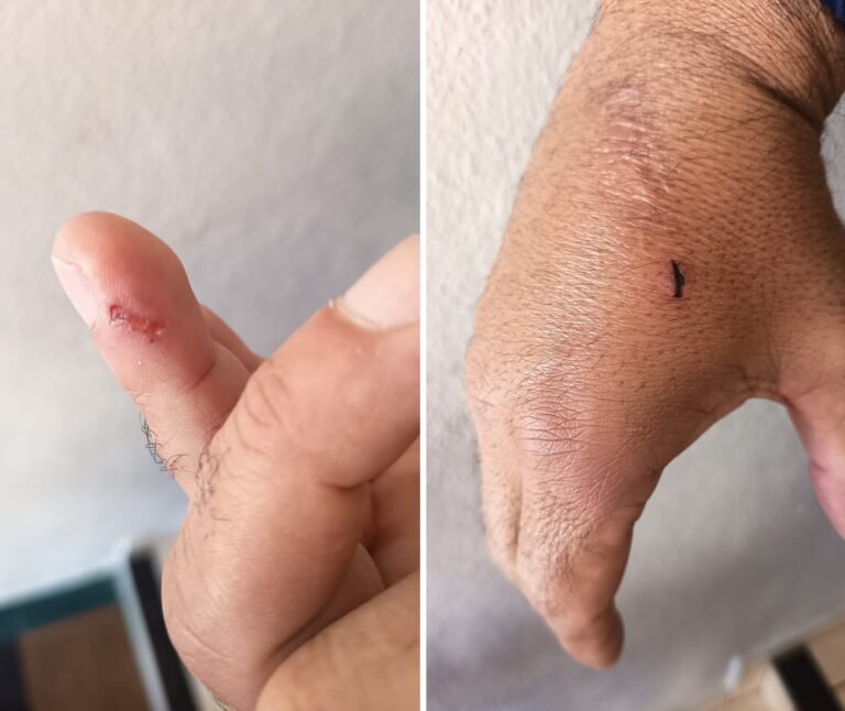 PMs afirmam que foram mordidos por homem durante abordagem em Bom Jesus do Itabapoana, no RJ