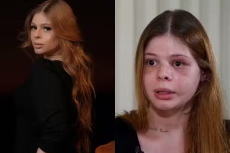 Médica espancada por namorado fisiculturista volta a morar com a mãe durante a recuperação: 'Meu sonho agora é ficar bem'
